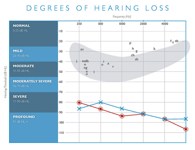 degrees of hearing loss